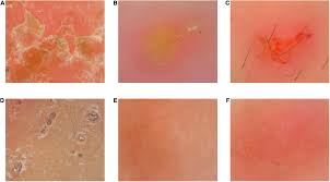 Image result for scabies human children