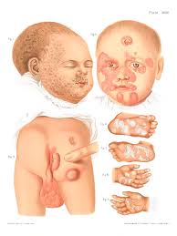 A narrative review / thomas a. Congenital Syphilis Photograph By Us National Library Of Medicine Science Photo Library