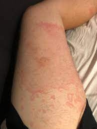Having An Allergic Reaction To Bedbug Bites Wellthatsucks