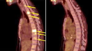 When cancer is metastatic, the cancer has traveled away from the breast and lymph nodes to other parts of the body, such as the bones, lungs, liver or brain. Kate Watson Breast Cancer Patient Story Cleveland Clinic