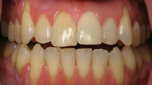 Gum (periodontal) disease is an infection of the gums and can affect the bone structure that supports your teeth. Gum Recession What Can I Do About My Receding Gums Dentist In Santa Rosa