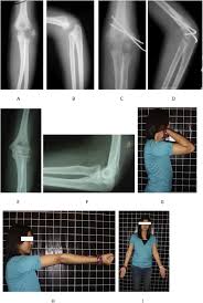 Image result for Lateral Condyle Fracture