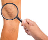 الدوالي عند الرجال في الساقين ويب طب