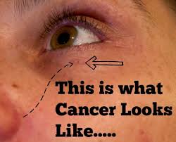 It may appear as crusty sores that are itchy, crusting, bleeding, or scabbed over. Dermatology