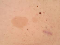 See 329 unbiased reviews of cafe au lait, rated 4 of 5 on tripadvisor and ranked #175 of 539 restaurants in bath. Cafe Au Lait Fleck Altmeyers Enzyklopadie Fachbereich Dermatologie
