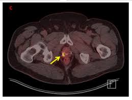 Pet Ct Imaging For Recurrent Pca Detection More Accurate With Psma Renal And Urology News