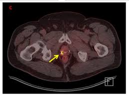 This new growth is still classified as prostate cancer because the. Pet Ct For Prostate Cancer From Diagnosis To Metastasis Renal And Urology News