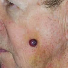 A normal merkel cell is a cross between a nerve cell and an endocrine (or. Ulcerated And Crusted Locally Advanced Merkel Cell Carcinoma Of The Download Scientific Diagram