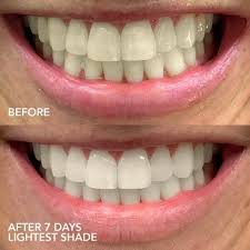 When it comes to professional teeth whitening, your dentist will determine how often you should get these based on several factors, like how healthy your teeth are. Glo Lit At Home Teeth Whitening Device Kit Glo Science Sephora