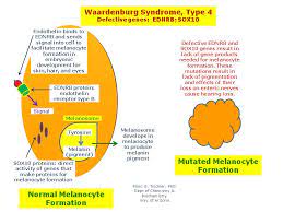Waardenburg Syndrome Type 4 Hereditary Ocular Diseases