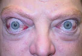 Is Graves Disease Fatal Eye Symptoms Treatment Diagnosis Diet