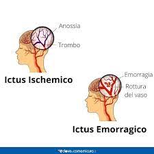 Circa il 10˛% degli ictus cerebrali sono causati da un'emorragia cerebrale. Ischemia Cerebrale Sintomi Cause Tipologie E Intervento