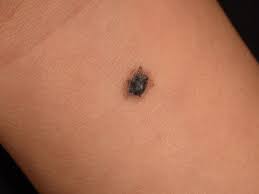 Image result for Spitz Nevus