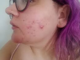 Hormonal Acne After The Depo Shot How To Fix It Skincareaddicts
