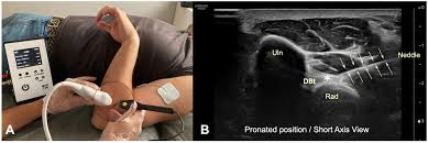 Image result for Biceps Tendon Injection