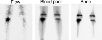 Image result for Osteomyelitis Bone Scan