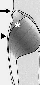 Iliac crest pain may also be a symptom of inflammation in the iliolumbar ligament. Common Diseases Mimicking Lumbar Disc Herniation And Their Treatment