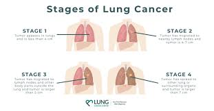 Image result for Lung Cancer