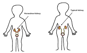 The Basics About Horseshoe Kidney