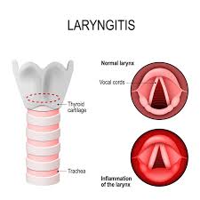 Chronic Laryngitis Guide Causes Symptoms And Treatment Options