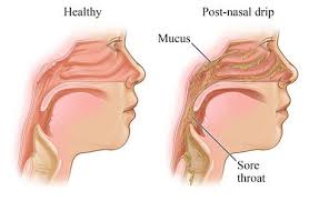 Pin On Acid Reflux Remedies