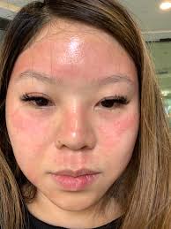 Any post-plasma skin needling skin care regimen?