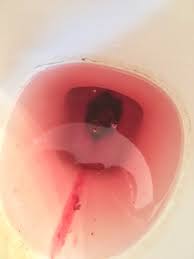 Miscarriage blood clots pictures 5 weeks. Graphic Threatened Miscarriage Or Miscarriage February 2021 Babies Forums What To Expect