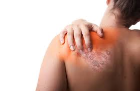 Image result for Varicella zoster on human skin