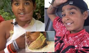 Boy, 12, is severely burned after friend dumped unknown liquid