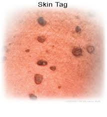 If you aren't sure which type of skin cancer. Skin Tags Causes Pictures Remedies Removal