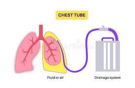 Image result for Chest Tube
