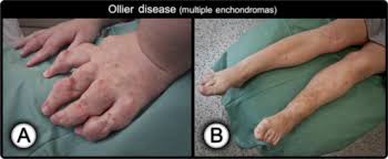 The Association Of Enchondromatosis With Malignant Transformed Chondrosarcoma And Ovarian Juvenile Granulosa Cell Tumor Ollier Disease Sciencedirect