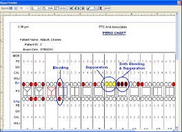 Show Bleeding And Or Suppuration When Printing Perio