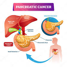Bodytomy elaborates more on the anatomy of the human pancreas. Pancreatic Cancer Vector Illustration Labeled Sick Stomach Oncology Disease Scheme Diagram With Inner Organs Structure Healthy And Tumor Comparison Liver Lobes Gallbladder And Intestine Example 292151642 Larastock