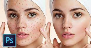 Photoshop Tutorial: The 5 Best Ways To Clean And Heal Skin Blemishes |  Petapixel