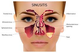 Is it safe to nexium while pregnant? What Can I Take For Sinus Infection While Breastfeeding