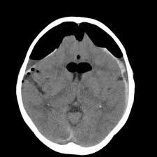 Tension Pneumocranium Eurorad