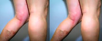 Conozca más sobre qué es, causas, síntomas y consecuencias de una trombosis cerebral Dolor De Pierna Y Otros Sintomas De Que Podrias Tener Una Trombosis