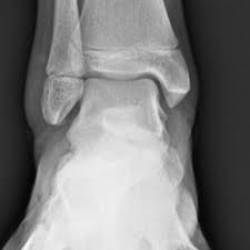 Image result for Ankle XRay