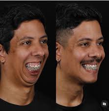 What did Kody do to his face?