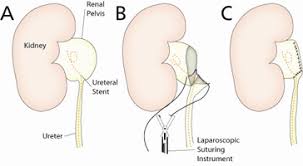 Robotic Pyeloplasty Bidmc Of Boston
