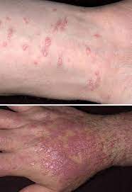 In weiterer folge kann es drei bis zehn tage nach krankheitsbeginn zur gelbfärbung von augen und haut (ikterus, die sogenannte gelbsucht) kommen. Lichen Ruber Planus Knotchenflechte Hauterkrankungen Msd Manual Ausgabe Fur Patienten