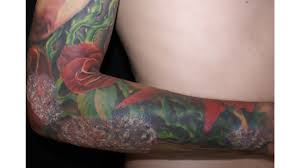 Hey, got this tattoo about a month ago and it has just recently started to become very itchy, raised and a lot of small bump like spots have formed all over it. Tattoo Rash Pimple Allergy Symptom Or Infection Plus Treatmen
