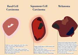 Main Type Of Skin Cancer — Their Differences, Histology And Prevention. —  Andréas Astier