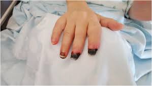 Finger und zehen können sich verfärben, absterben und müssen möglicherweise amputiert werden. Rare Case Of Symmetrical Peripheral Gangrene Due To Septic Shock Disseminated Intravascular Coagulation And Inotropic Use Sciencedirect