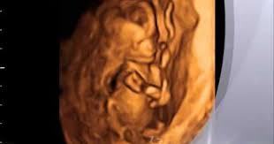 13 Weeks 6 Days Baby Girl At Hopes Dreams 3d 4d Ultrasound Ultrasound 4d Ultrasound Gender Reveal Ultrasound