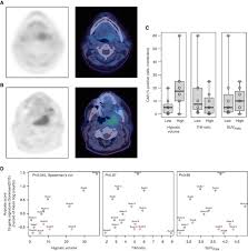We apologize for the inconvenience. Association Between Hypoxic Volume And Underlying Hypoxia Induced Gene Expression In Oropharyngeal Squamous Cell Carcinoma British Journal Of Cancer
