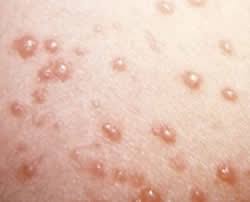 Unele dintre ele au și puroi și sunt dureroase? Bolile Infecto Contagioase Ale Copilariei