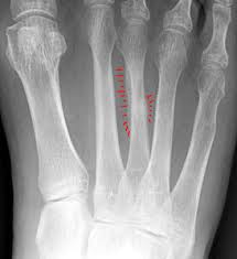 The bone's integrity can be completely. Test Your X Ray Iq Why Is This Patient Experiencing Foot Pain Airrosti