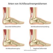 Haglundferse Ursachen Symptome Behandlung